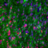 glioblastoma multiforme